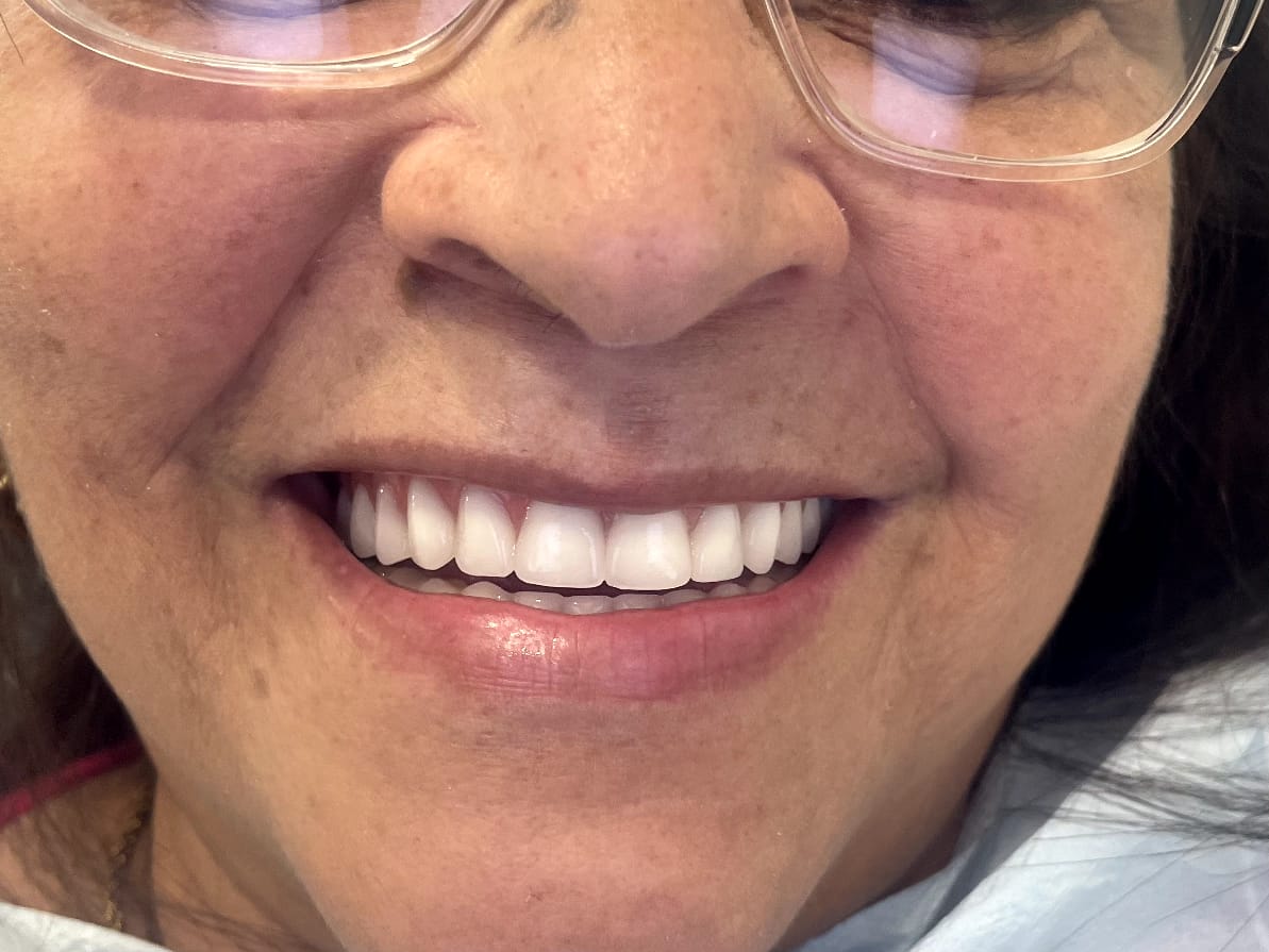 Depois — Recuperação do sorriso