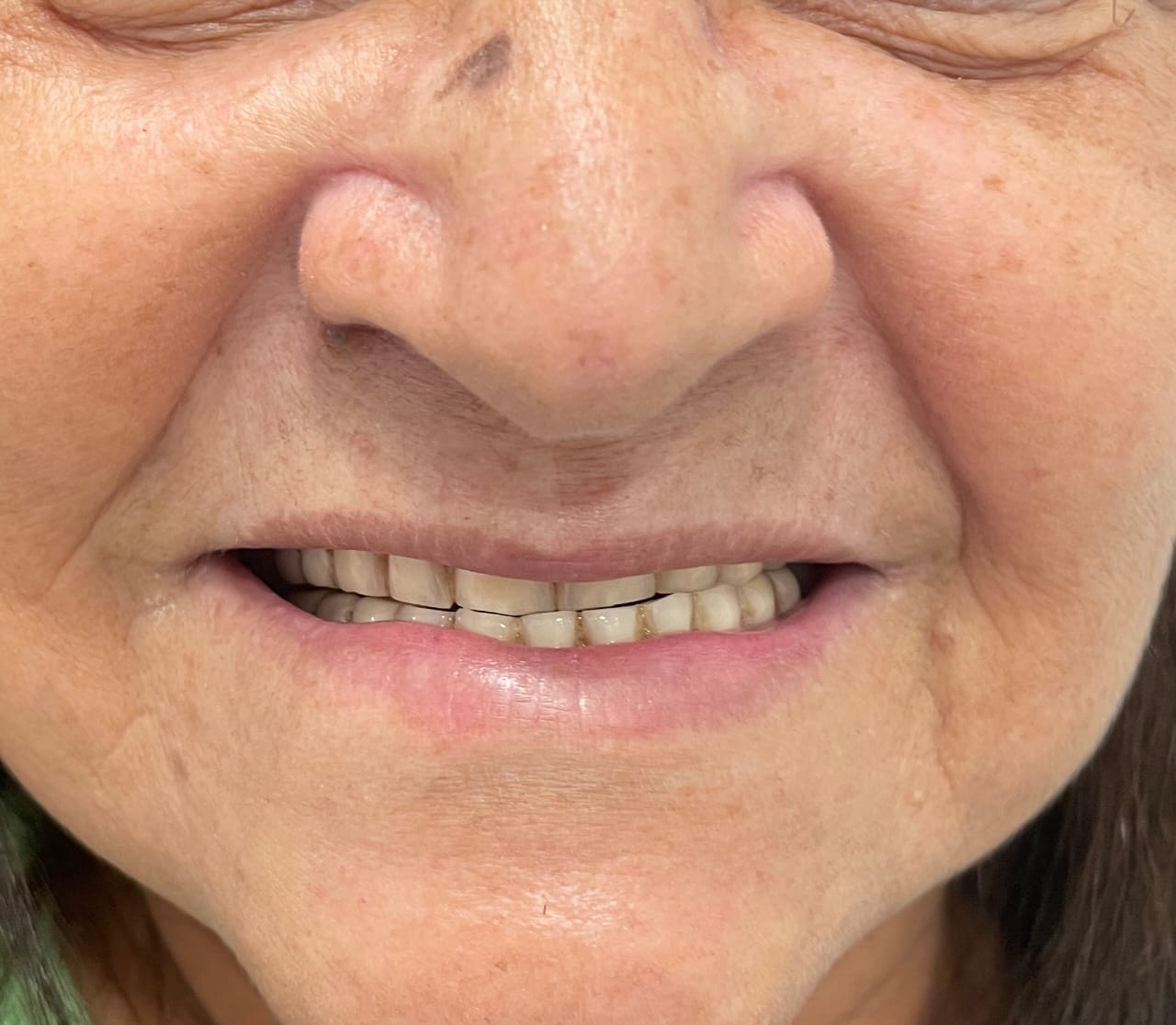 Antes — Recuperação do sorriso