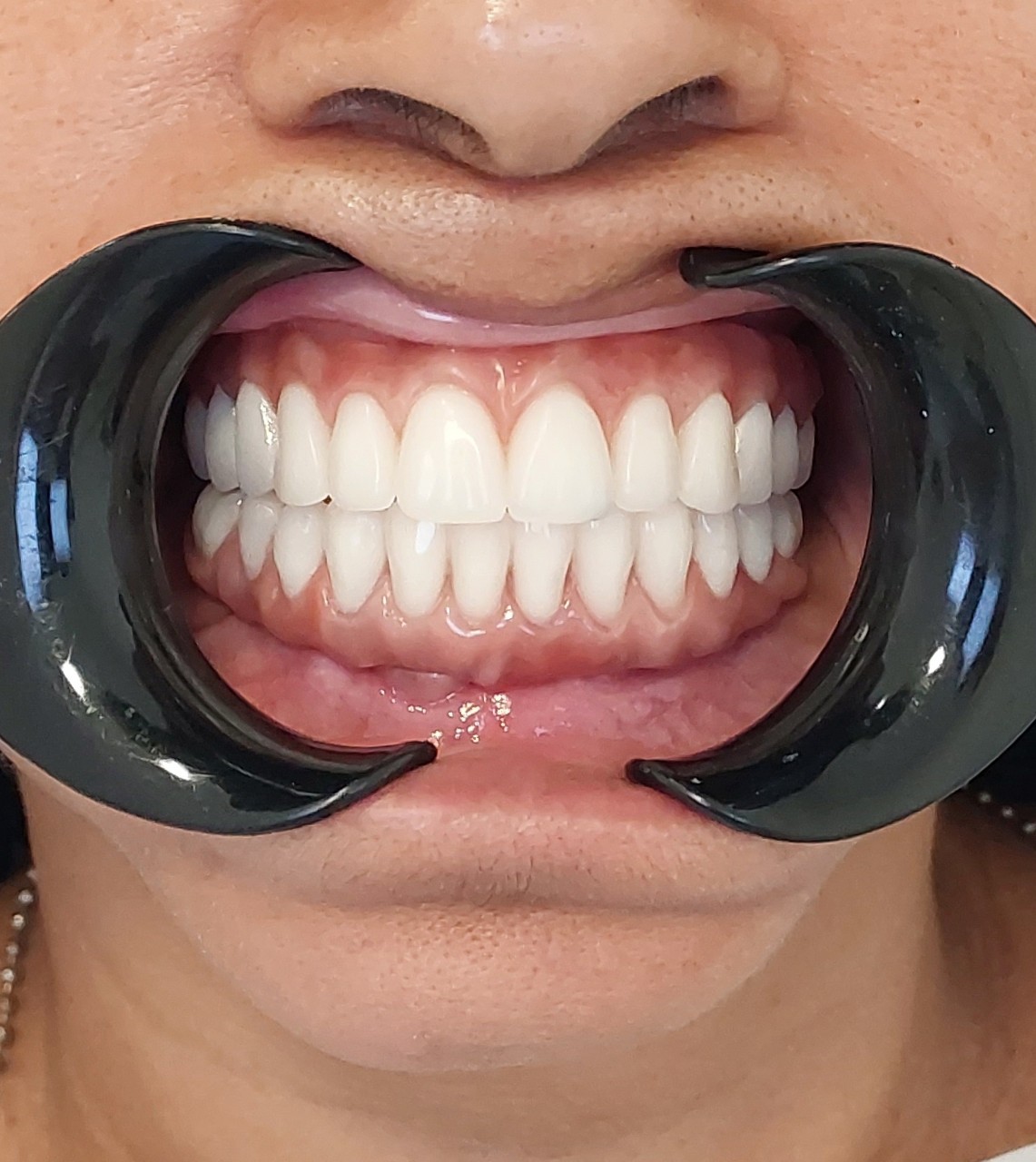 Depois — Substituição de dentes comprometidos